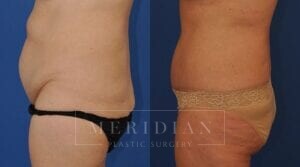 tjelmeland-meridian-austin-liposuction-patient-28-3