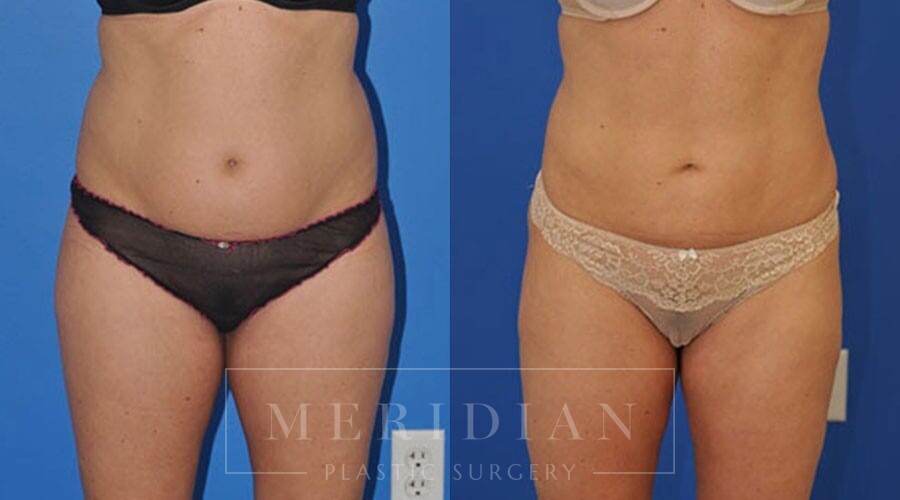 tjelmeland-meridian-austin-liposuction-patient-3-1