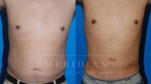 tjelmeland-meridian-austin-liposuction-patient-4-1
