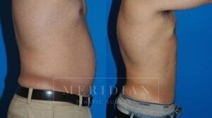 tjelmeland-meridian-austin-liposuction-patient-4-2