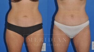 tjelmeland-meridian-austin-liposuction-patient-5-1