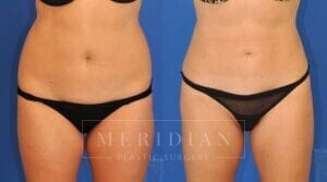 tjelmeland-meridian-austin-liposuction-patient-6-1