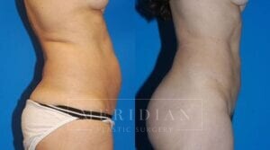 tjelmeland-meridian-austin-liposuction-patient-7-2