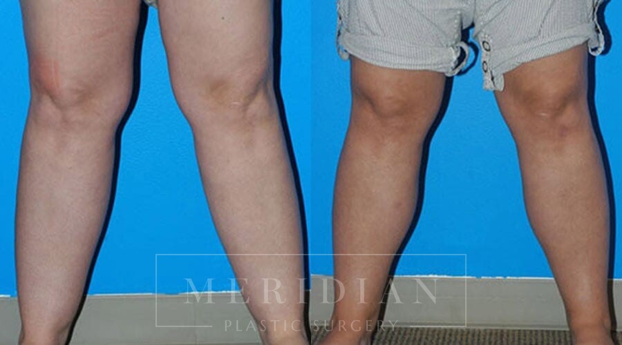 tjelmeland-meridian-austin-liposuction-patient-8-1