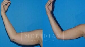 tjelmeland-meridian-austin-liposuction-patient-9-1