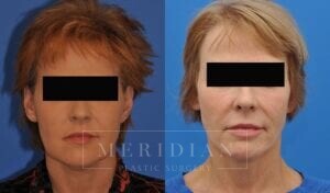 tjelmeland-meridian-austin-neck-lift-patient-7-1