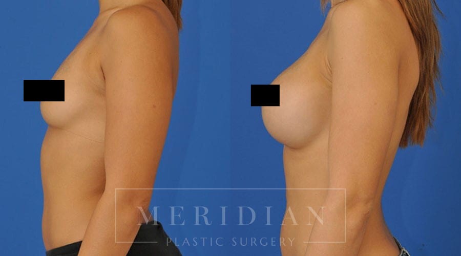 tjelmeland-meridian-austin-breast-augmentation-patient-36-2censored