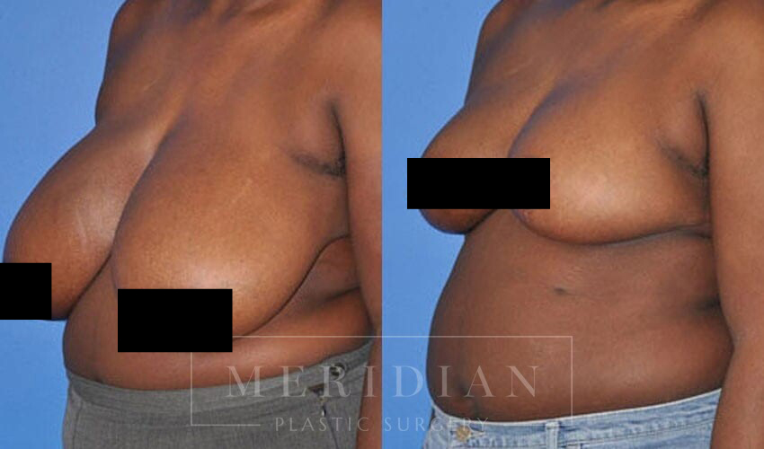 Breast Reduction Surgery Looks More Prominent - Dermaster