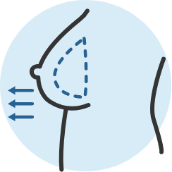 meridian plastic surgery breast 1 implant removal 2 Meridian Plastic Surgery Center meridian plastic surgery breast 1 implant removal 2